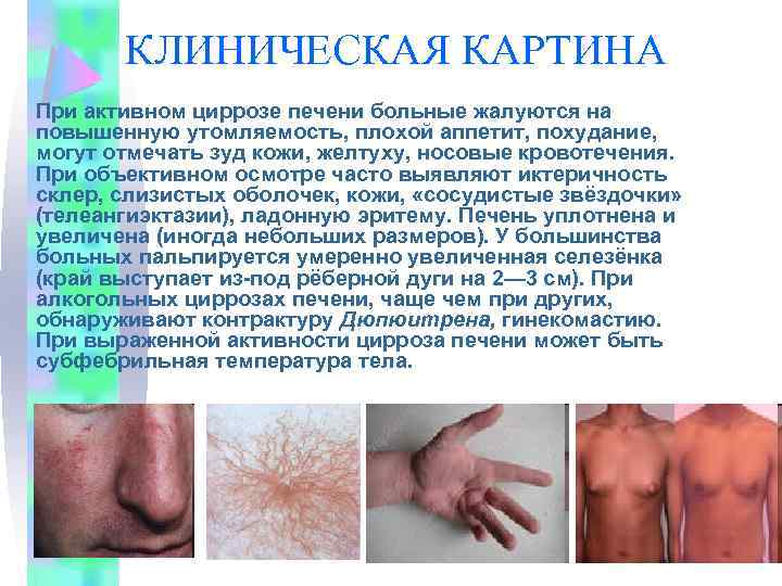 КЛИНИЧЕСКАЯ КАРТИНА При активном циррозе печени больные жалуются на повышенную утомляемость, плохой аппетит, похудание,