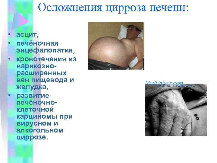 Осложнения цирроза печени: • асцит, • печёночная энцефалопатия, • кровотечения из варикозно расширенных вен