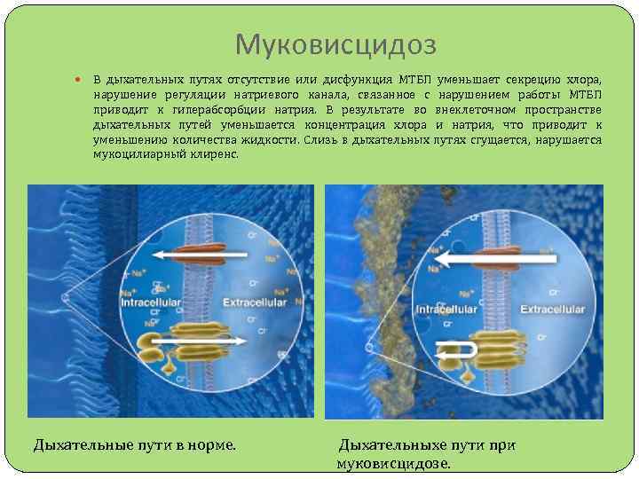 В одной европейской популяции муковисцидоз. Муковисцидоз этиология и патогенез. Муковисцидоз патогенез. Муковисцидоз механизм. Муковисцидоз хлорный канал.