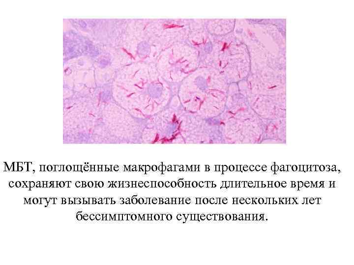 МБТ, поглощённые макрофагами в процессе фагоцитоза, сохраняют свою жизнеспособность длительное время и могут вызывать