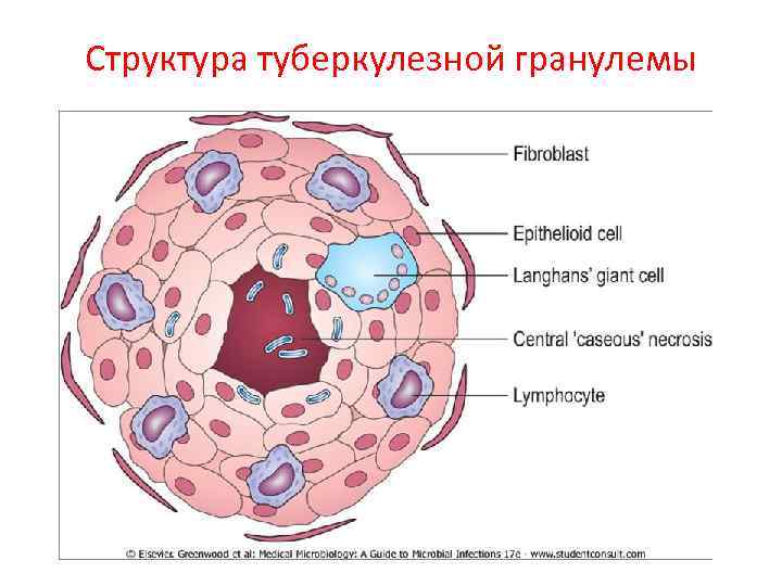 Структура туберкулезной гранулемы 