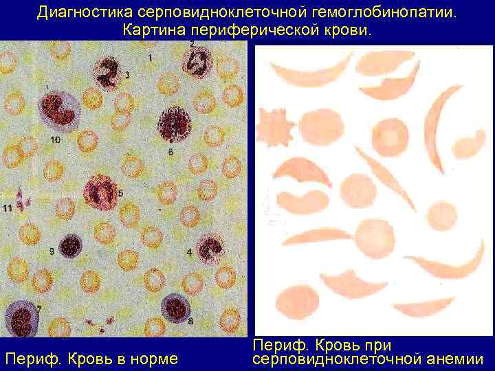 Диагностика серповидноклеточной гемоглобинопатии. Картина периферической крови. Периф. Кровь в норме Периф. Кровь при серповидноклеточной
