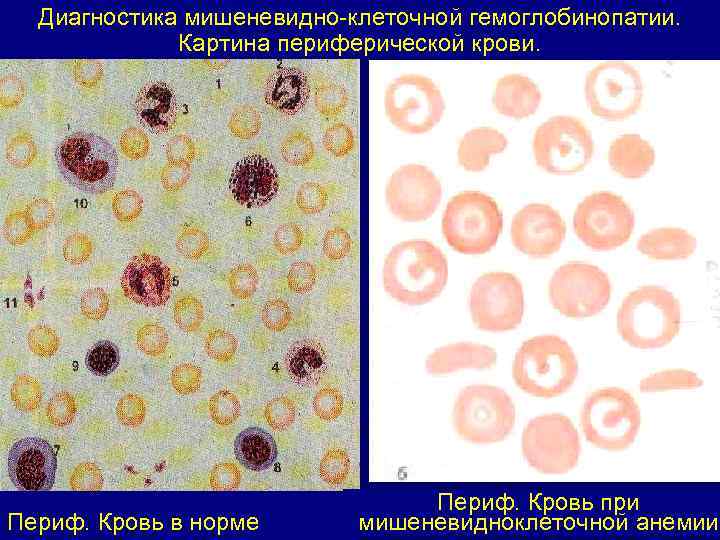Диагностика мишеневидно-клеточной гемоглобинопатии. Картина периферической крови. Периф. Кровь в норме Периф. Кровь при мишеневидноклеточной
