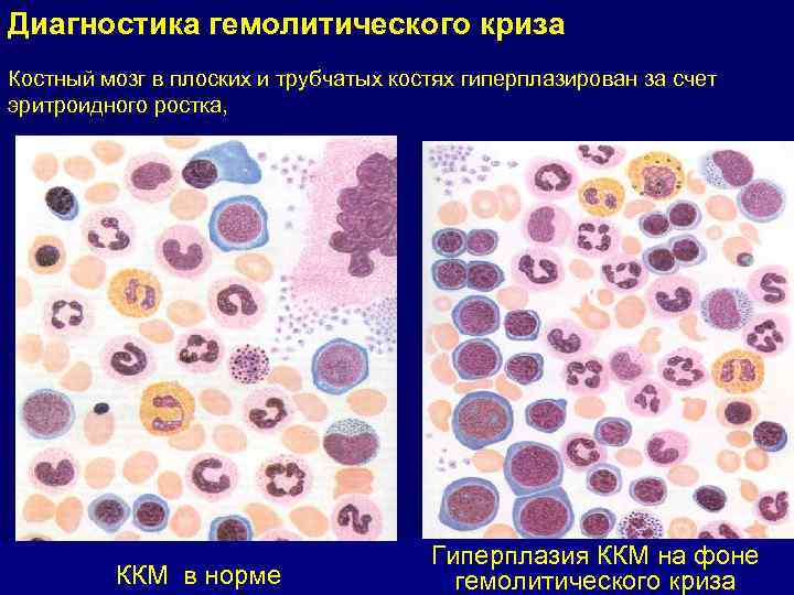 Диагностика гемолитического криза Костный мозг в плоских и трубчатых костях гиперплазирован за счет эритроидного
