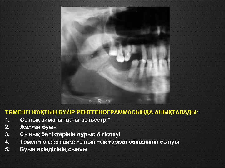 Переломы нижней челюсти стоматология презентация