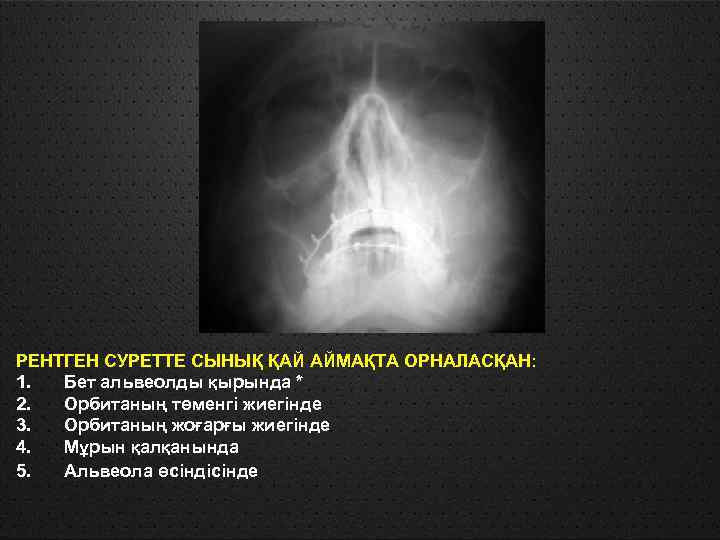 РЕНТГЕН СУРЕТТЕ СЫНЫҚ ҚАЙ АЙМАҚТА ОРНАЛАСҚАН: 1. Бет альвеолды қырында * 2. Орбитаның төменгі