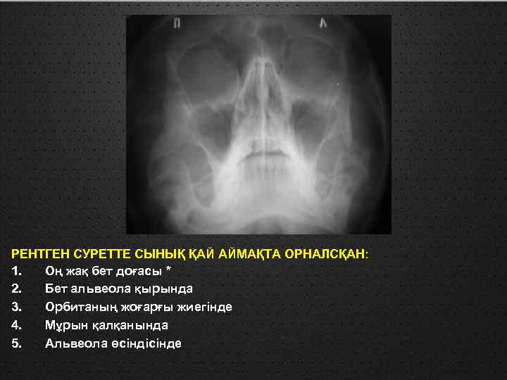 РЕНТГЕН СУРЕТТЕ СЫНЫҚ ҚАЙ АЙМАҚТА ОРНАЛСҚАН: 1. Оң жақ бет доғасы * 2. Бет