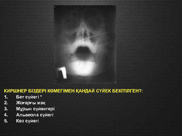 КИРШНЕР БІЗДЕРІ КӨМЕГІМЕН ҚАНДАЙ СҮЙЕК БЕКІТІЛГЕН? : 1. Бет сүйегі * 2. Жоғарғы жақ