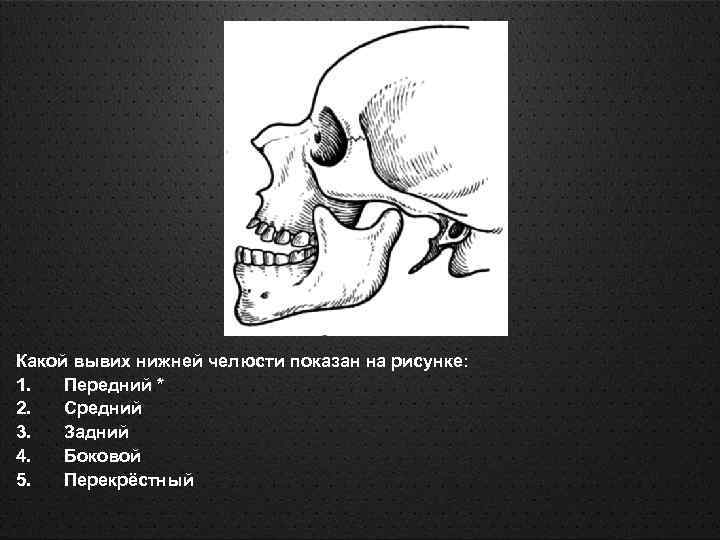 Какой вывих нижней челюсти показан на рисунке: 1. Передний * 2. Средний 3. Задний