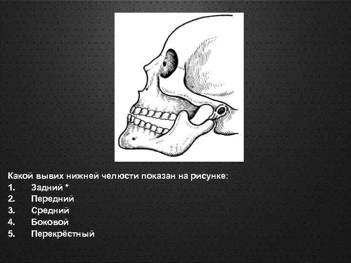 Вывих челюсти. Задний вывих нижней челюсти. Передний односторонний вывих нижней челюсти. Двухсторонний вывих нижней челюсти. Виды вывихов нижней челюсти.