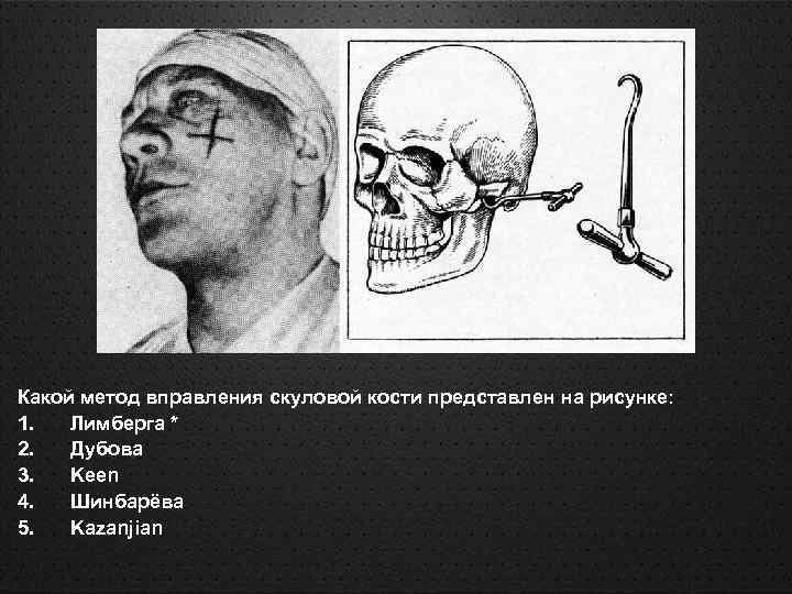 Переломы скуловой кости и дуги презентация