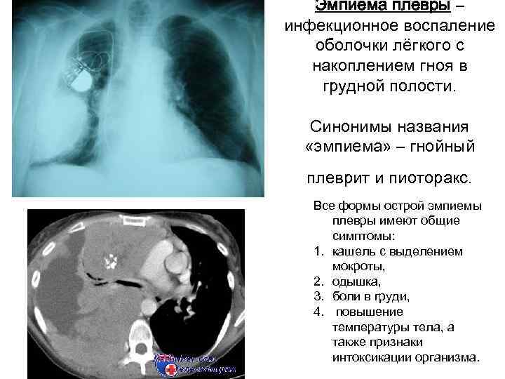 Эмпиема плевры кт фото