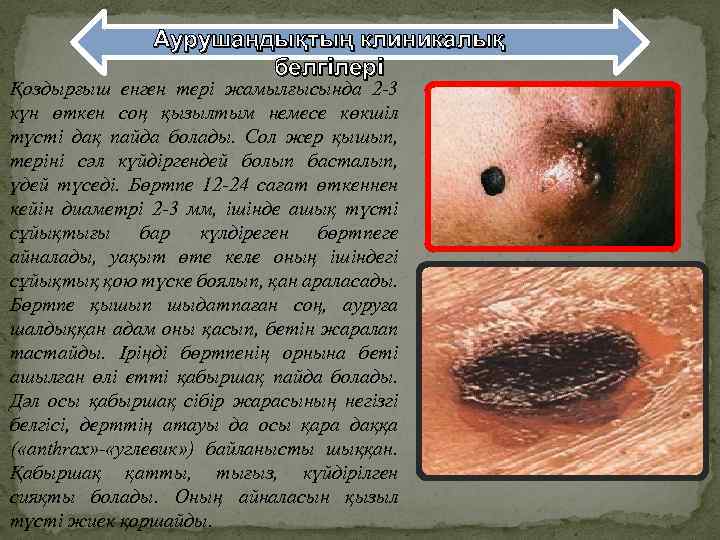 Аурушаңдықтың клиникалық белгілері Қоздырғыш енген тері жамылғысында 2 -3 күн өткен соң қызылтым немесе