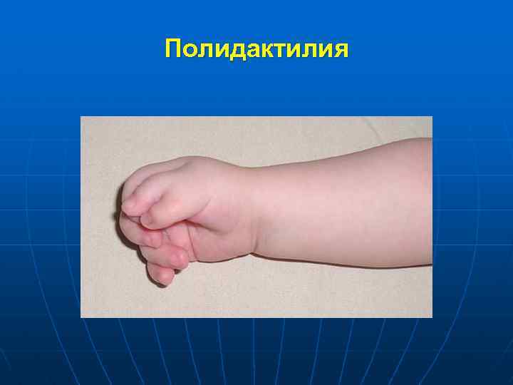 Полидактилия 