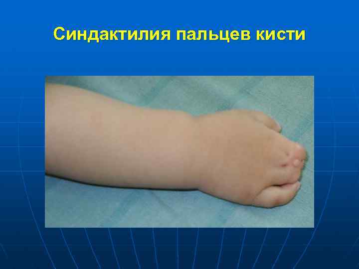 Синдактилия пальцев кисти 