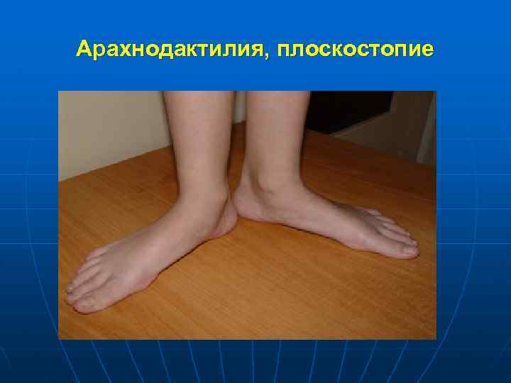 Арахнодактилия, плоскостопие 