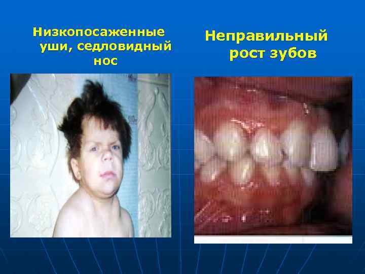 Низкопосаженные уши, седловидный нос Неправильный рост зубов 
