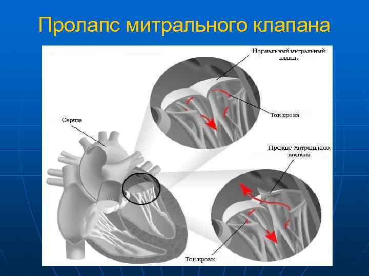 Пролапс митрального клапана 