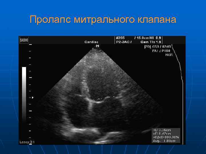 Пролапс митрального клапана 