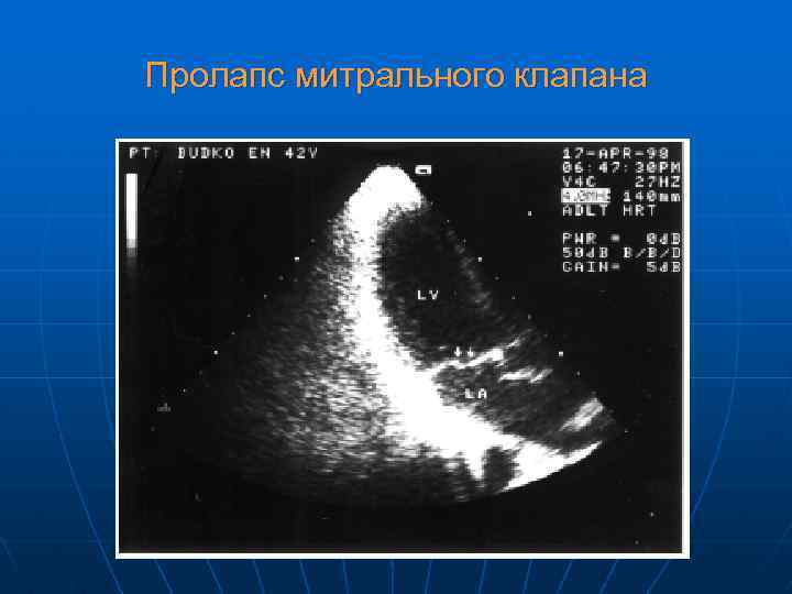 Пролапс митрального клапана 