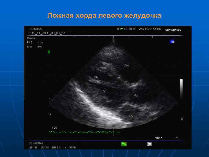 Ложная хорда левого желудочка 