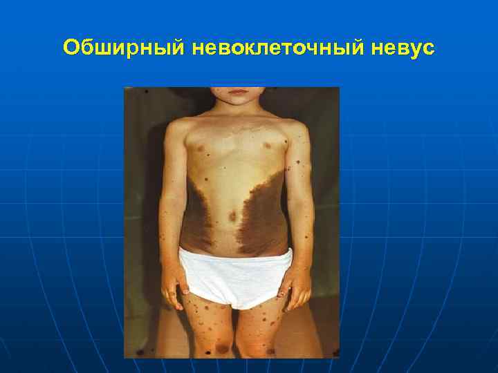 Обширный невоклеточный невус 