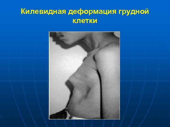 Килевидная деформация грудной клетки 