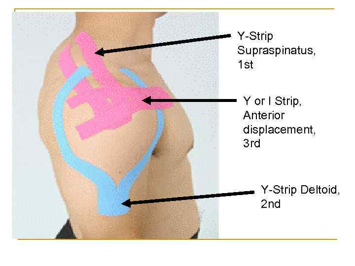 Y-Strip Supraspinatus, 1 st Y or I Strip, Anterior displacement, 3 rd Y-Strip Deltoid,