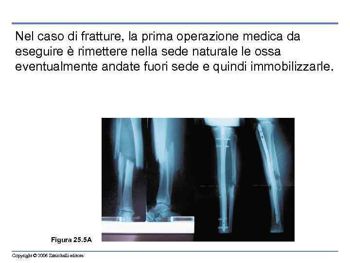 Nel caso di fratture, la prima operazione medica da eseguire è rimettere nella sede