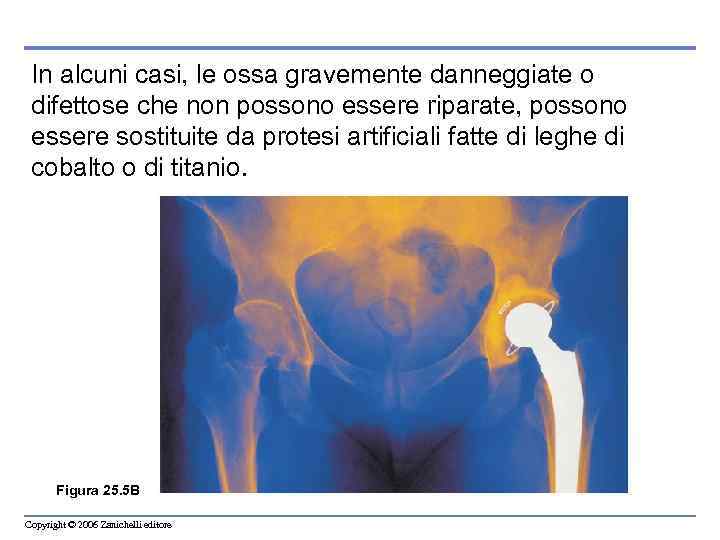 In alcuni casi, le ossa gravemente danneggiate o difettose che non possono essere riparate,