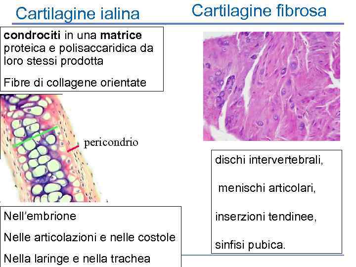 Cartilagine ialina Cartilagine fibrosa condrociti in una matrice proteica e polisaccaridica da loro stessi