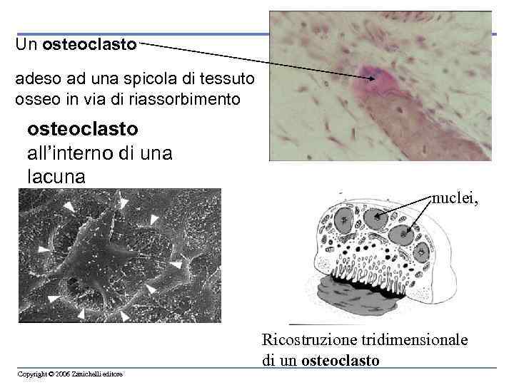 Un osteoclasto adeso ad una spicola di tessuto osseo in via di riassorbimento osteoclasto