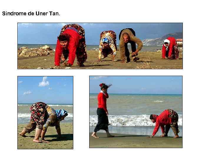 Sindrome de Uner Tan. 