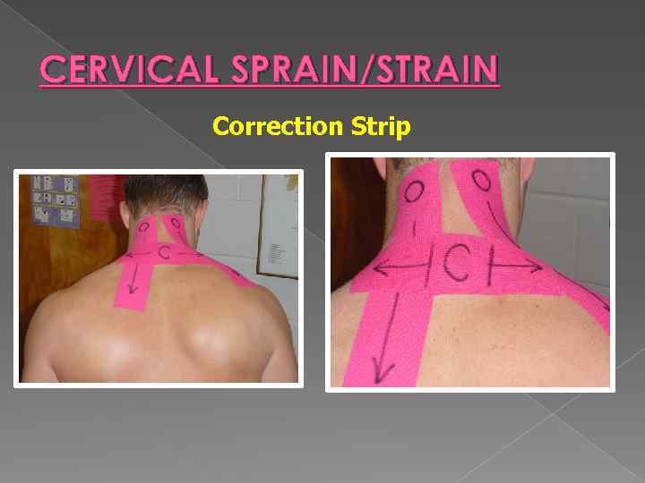 CERVICAL SPRAIN/STRAIN Correction Strip 