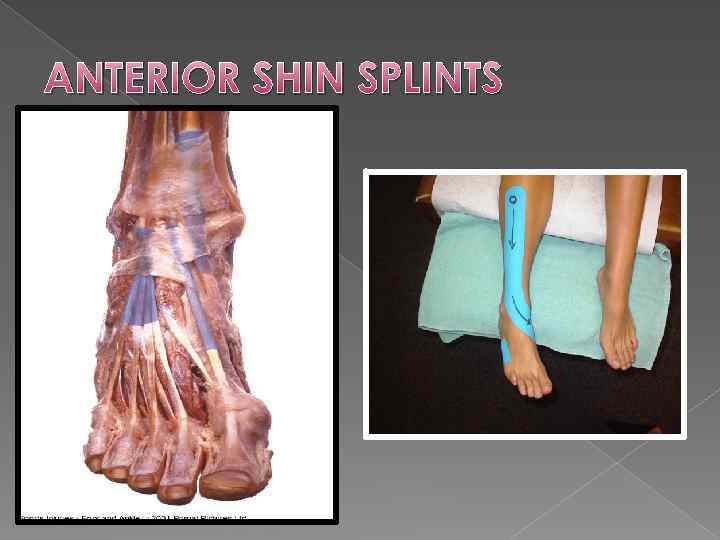 ANTERIOR SHIN SPLINTS 