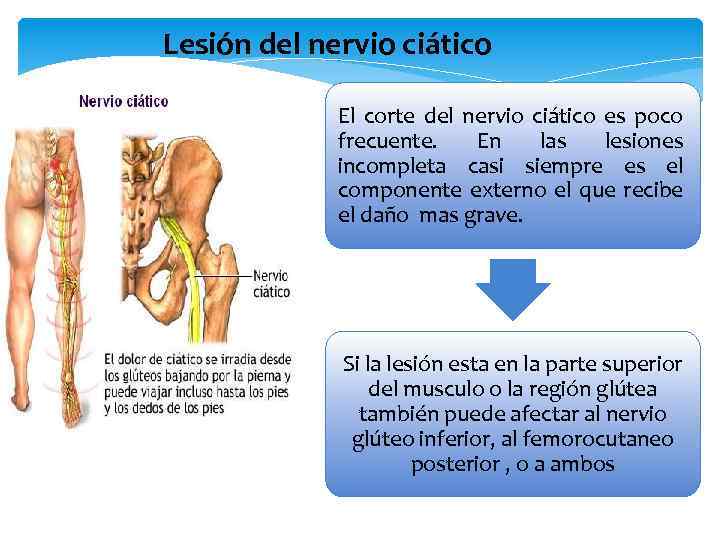 Lesión del nervio ciático El corte del nervio ciático es poco frecuente. En las