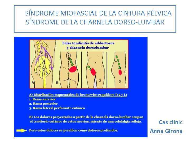 SÍNDROME MIOFASCIAL DE LA CINTURA PÉLVICA SÍNDROME DE LA CHARNELA DORSO-LUMBAR Cas clínic Anna