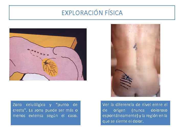 EXPLORACIÓN FÍSICA Zona celulálgica y “punto de cresta”. La zona puede ser más o