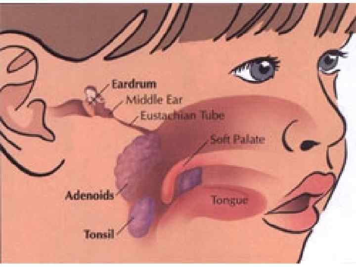 Где находятся аденоиды у ребенка картинка
