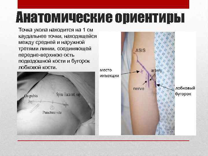 Анатомические ориентиры Точка укола находится на 1 см каудальнее точки, находящейся между средней и