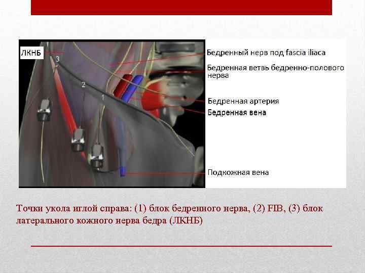Точки укола иглой справа: (1) блок бедренного нерва, (2) FIB, (3) блок латерального кожного