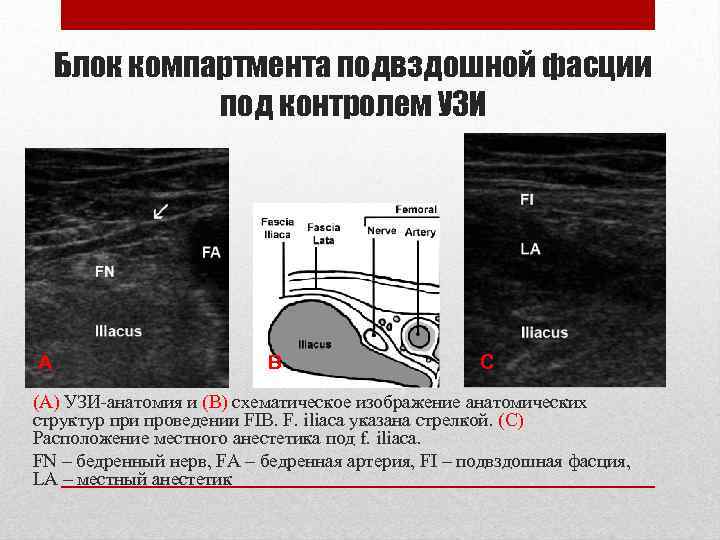 Блок компартмента подвздошной фасции под контролем УЗИ А В С (А) УЗИ-анатомия и (B)