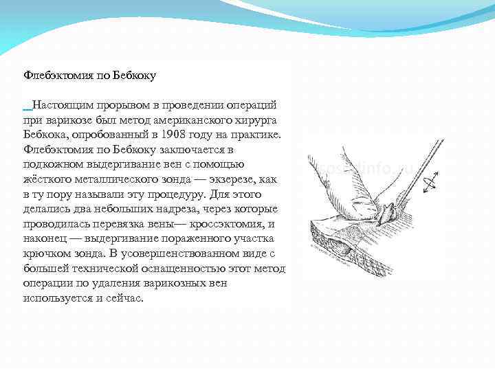 Флебэктомия по Бебкоку Настоящим прорывом в проведении операций при варикозе был метод американского хирурга
