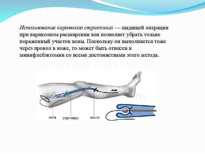 Использование короткого стриппинга — щадящей операции при варикозном расширении вен позволяет убрать только пораженный