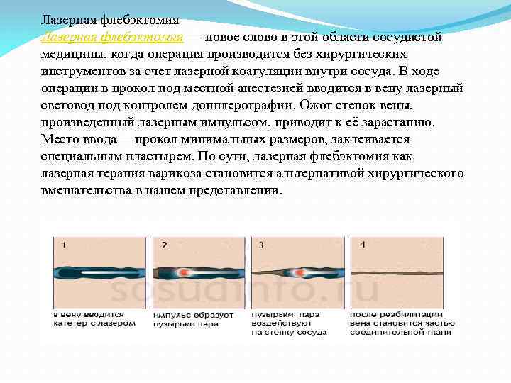 Лазерная флебэктомия — новое слово в этой области сосудистой медицины, когда операция производится без