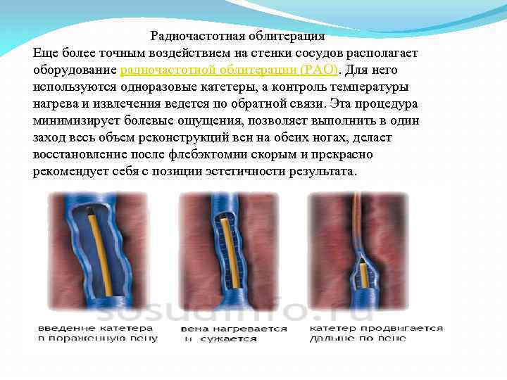 Радиочастотная облитерация Еще более точным воздействием на стенки сосудов располагает оборудование радиочастотной облитерации (РАО).