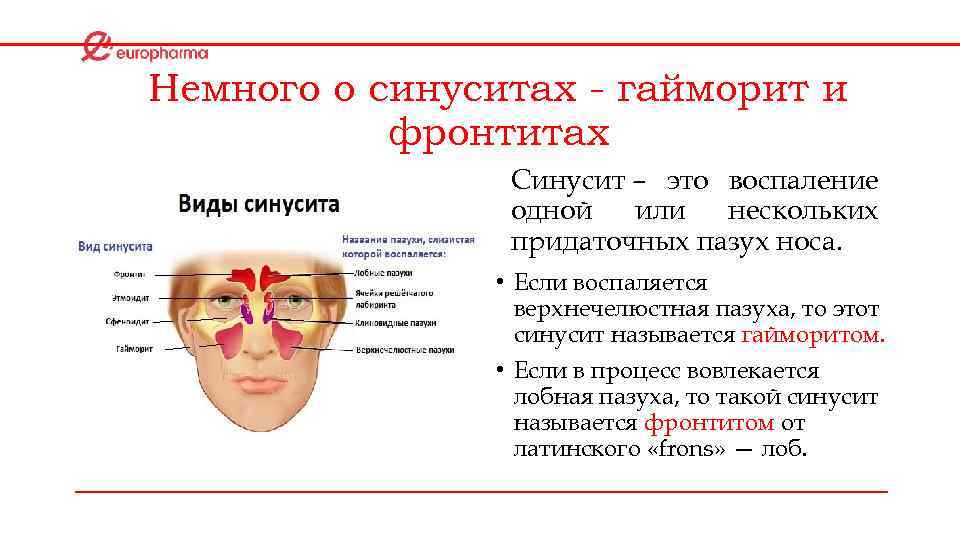 Немного о синуситах - гайморит и фронтитах Синусит – это воспаление одной или нескольких