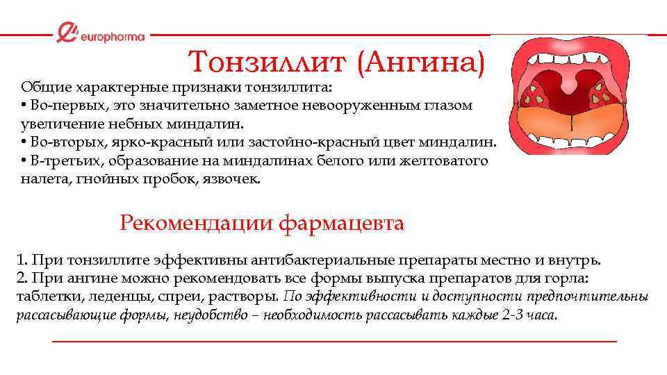 Тонзиллит (Ангина) Общие характерные признаки тонзиллита: • Во-первых, это значительно заметное невооруженным глазом увеличение