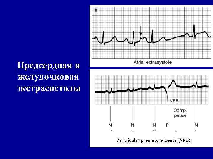 Предсердная и желудочковая экстрасистолы 