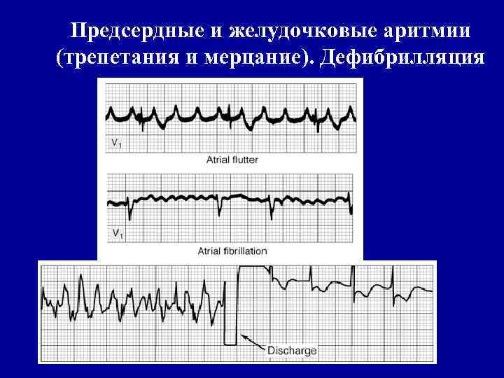 Предсердные и желудочковые аритмии (трепетания и мерцание). Дефибрилляция 